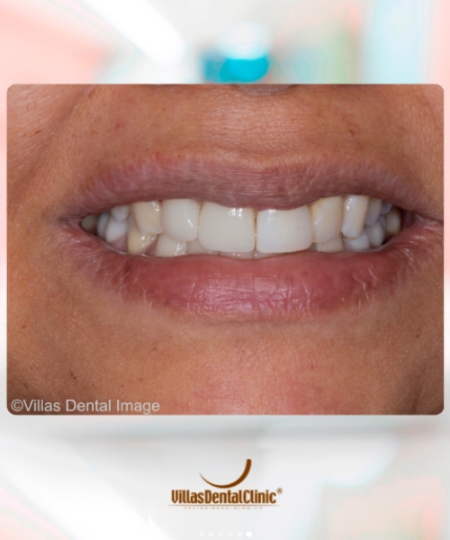 Implante dentário VIllas Dental
