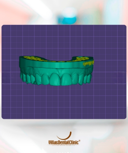 implante-dentario-villas-dental-clinic2