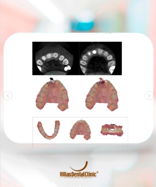 implante-dentario-villas-dental-clinic3