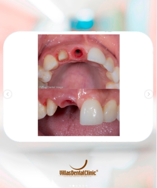 implante-dentario-villas-dental-clinic6