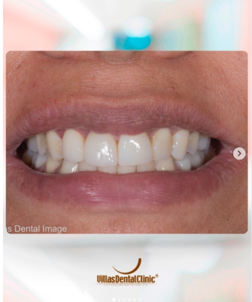 implante-dentario-villas-dental-clinic7